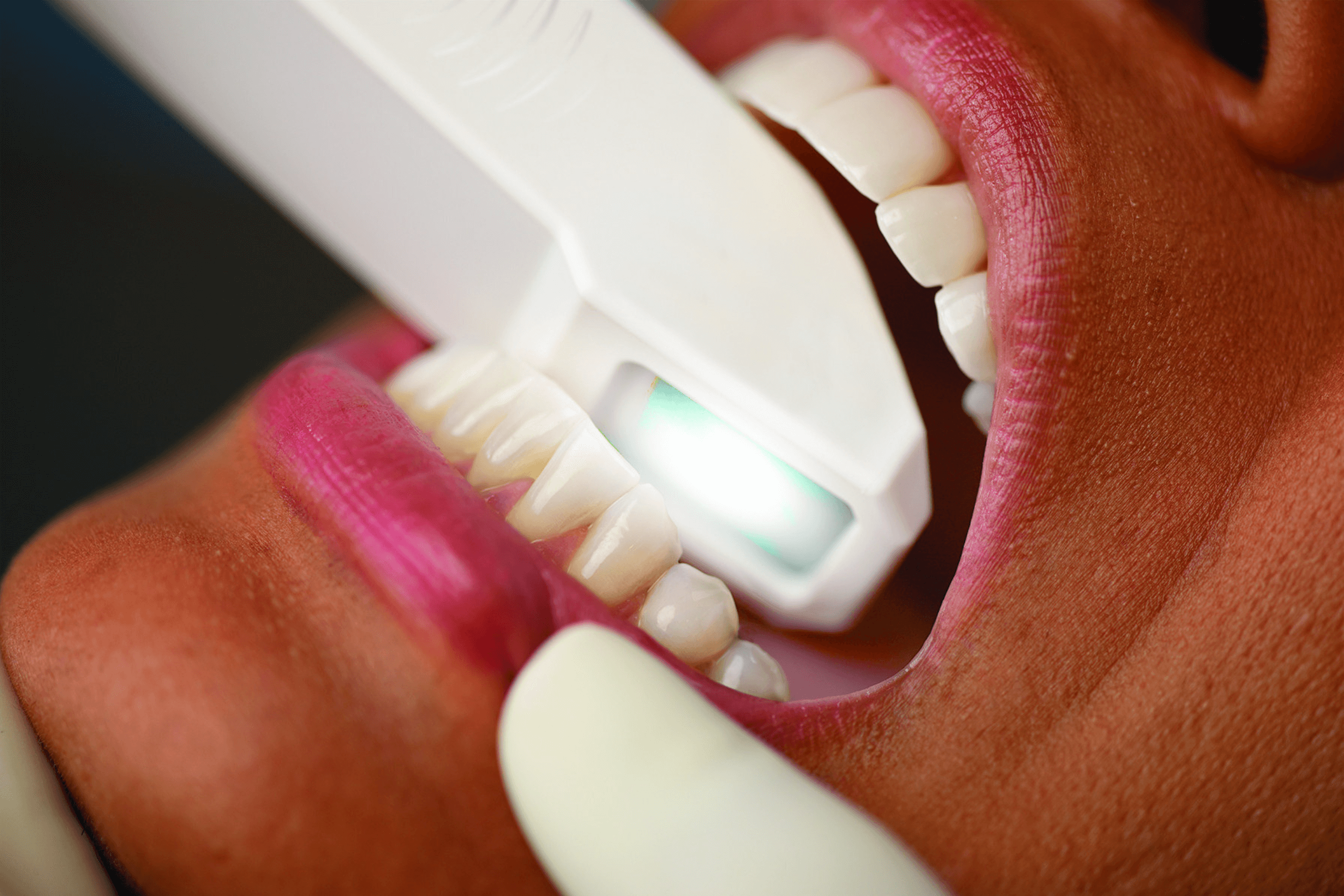3D teeth scan for planning a straight smile
