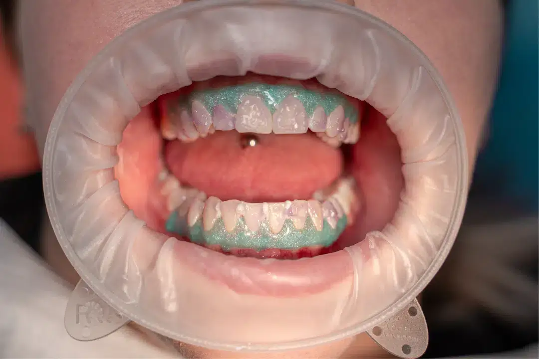 Applying whitening gel to teeth