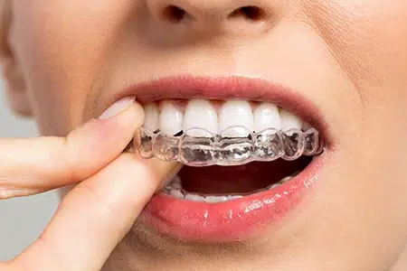 Invisible clear aligner