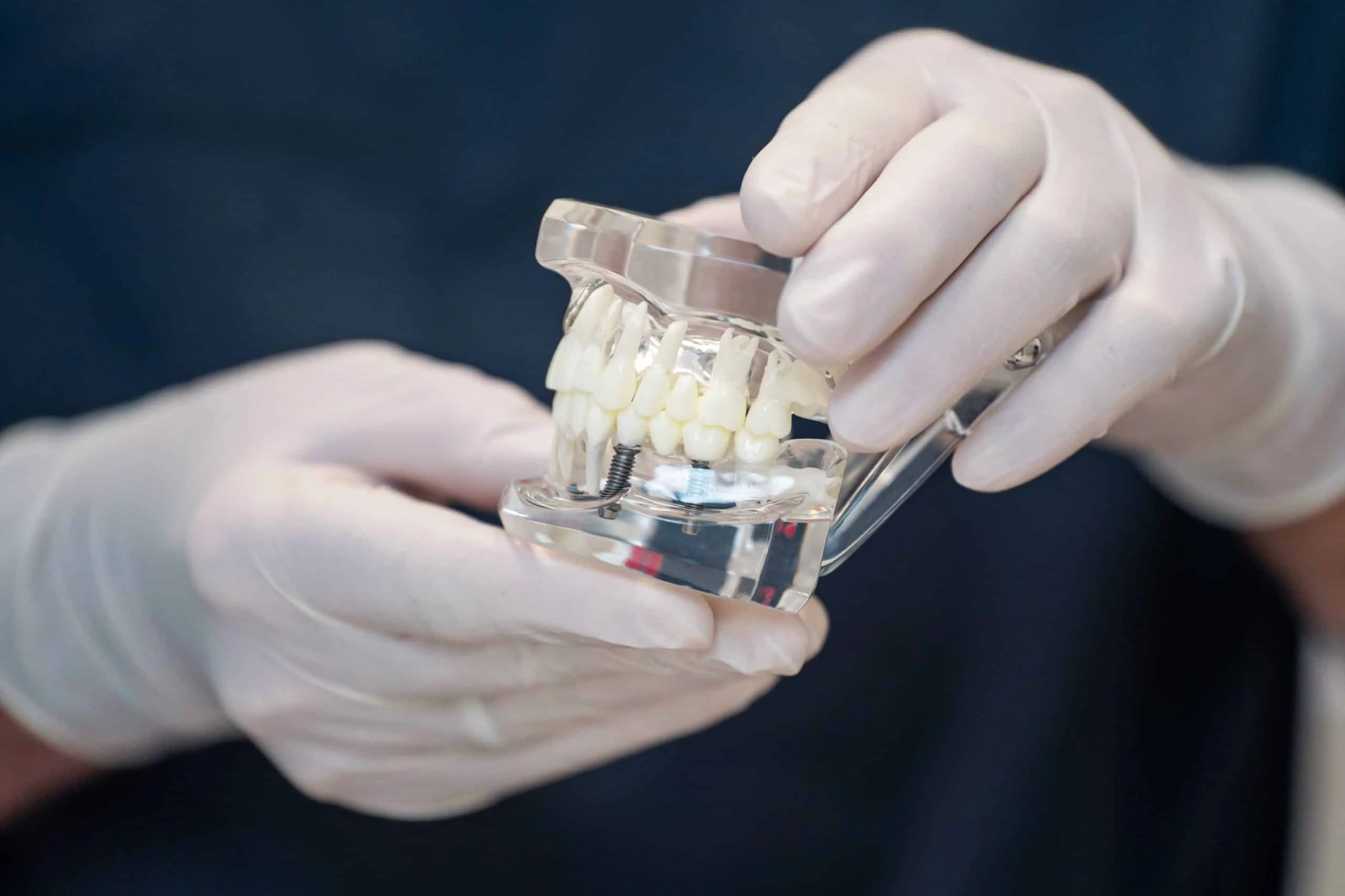 Ceramic dental implants cost