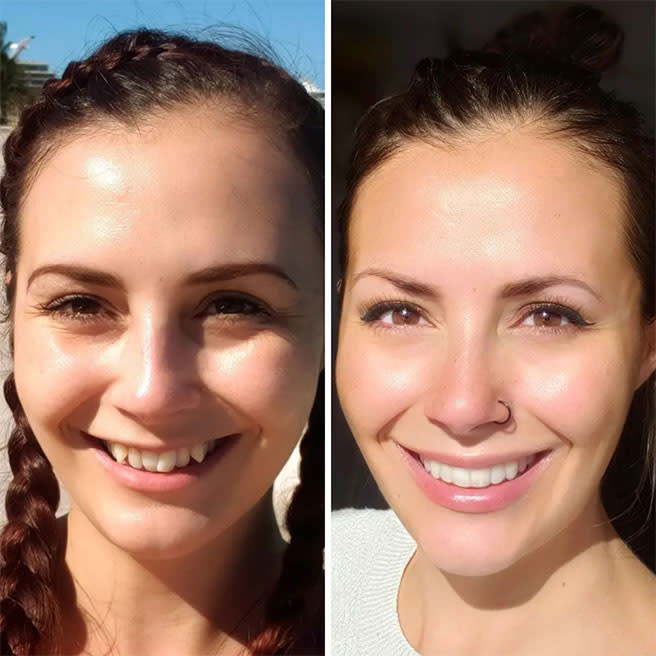 Before and after Invisalign treatment