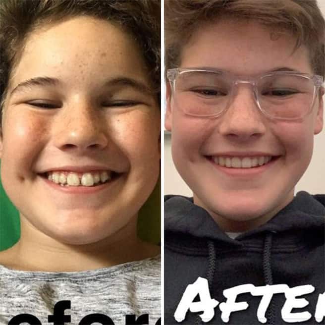 Invisalign First for young children