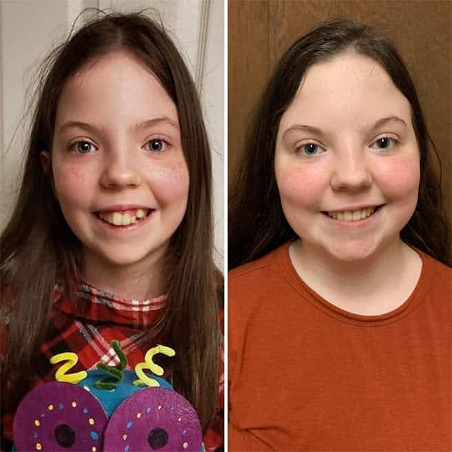 Invisalign Teen clear aligners