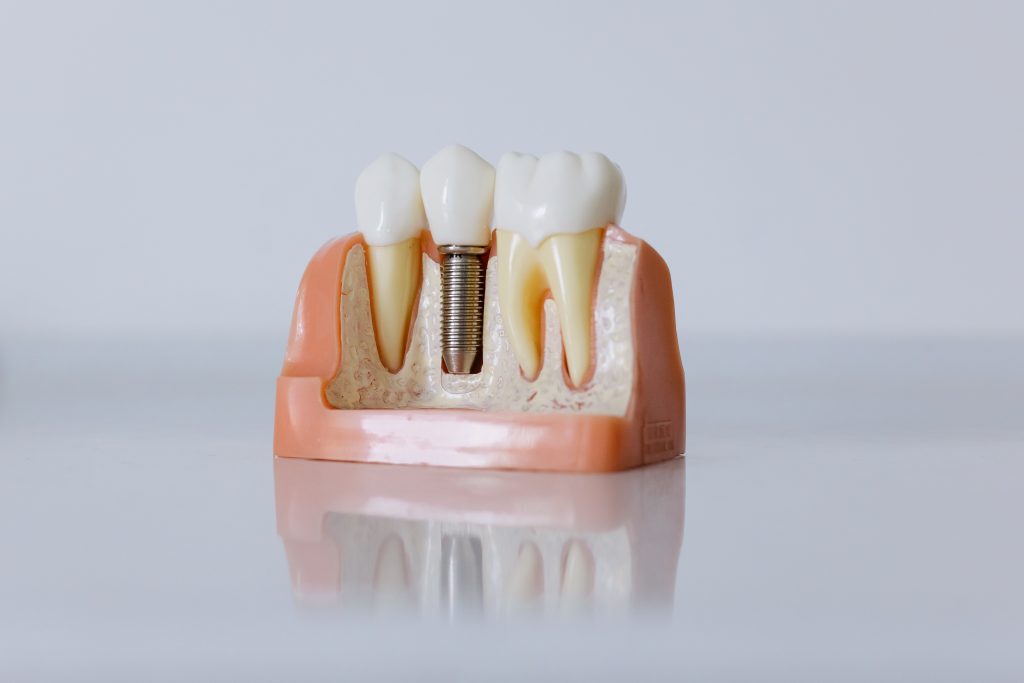 How dental implant looks like