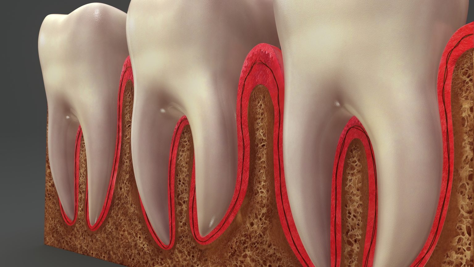 The picture showing the periodontal disease