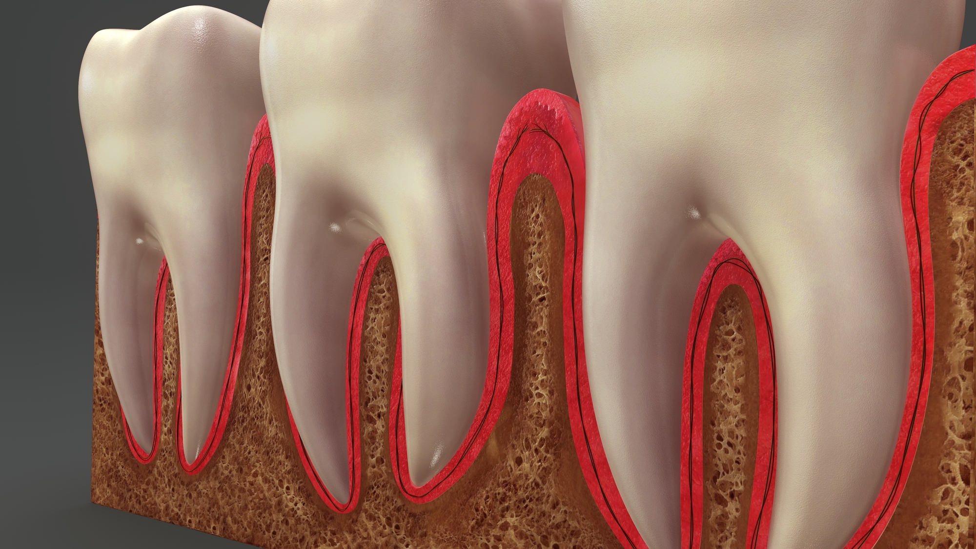 Periodontitis treatment