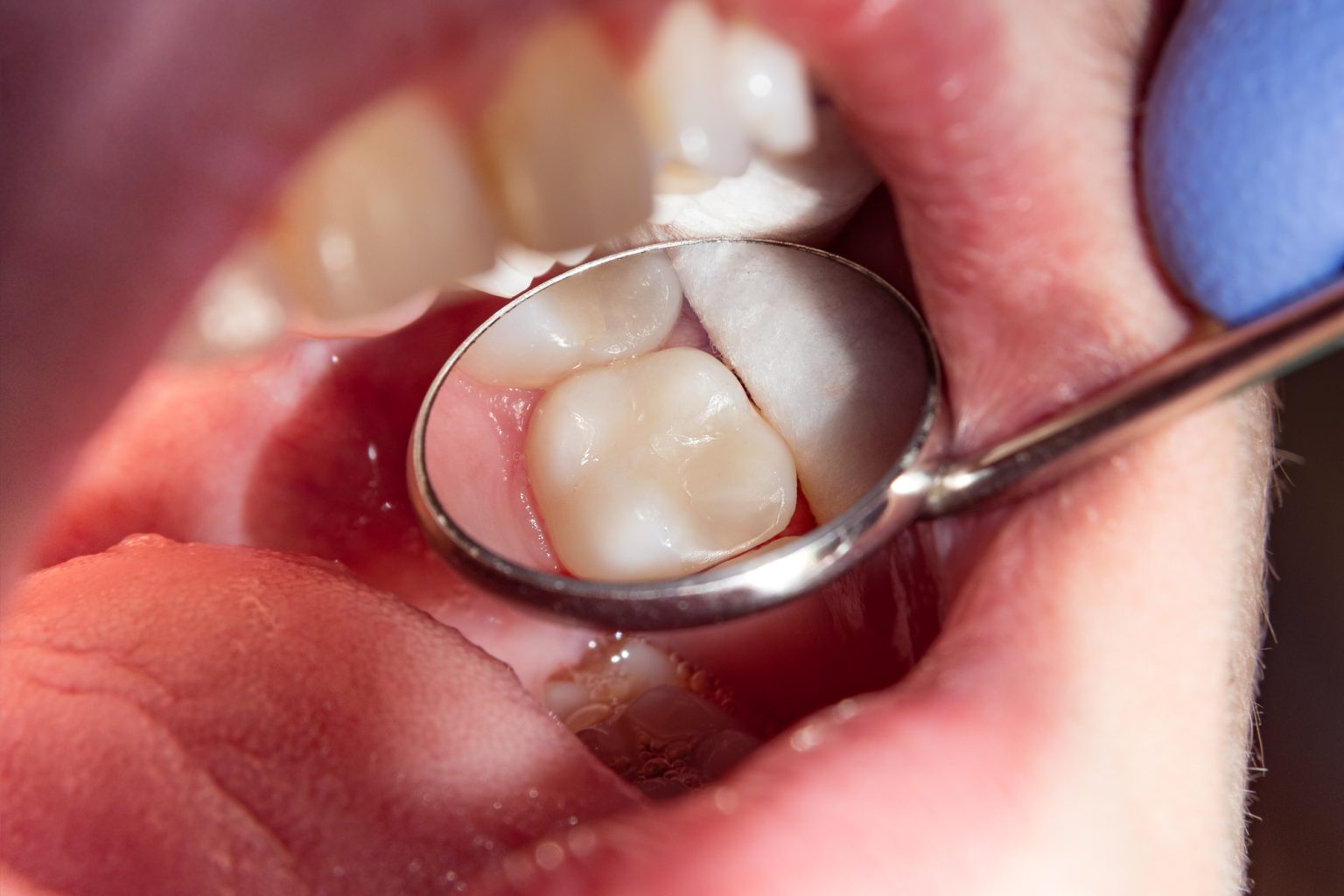 Picture of white dental filling in the mouth