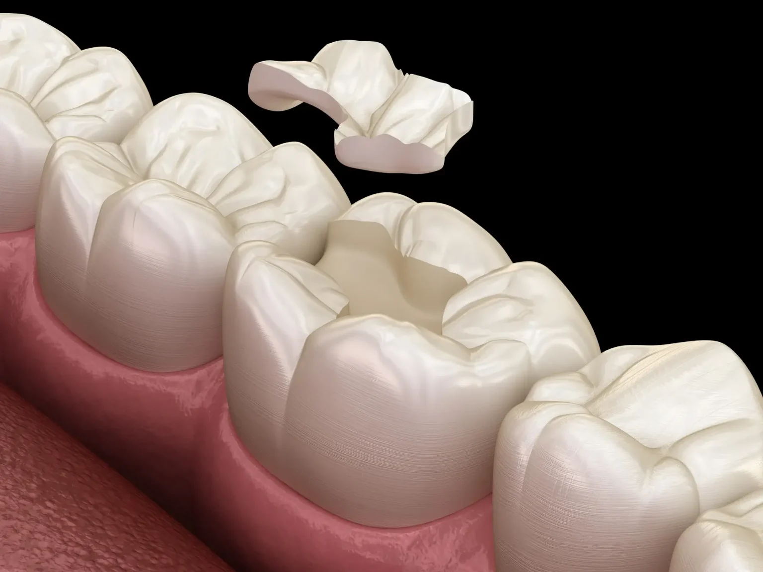 3D render of a dental inlay fitted into a molar