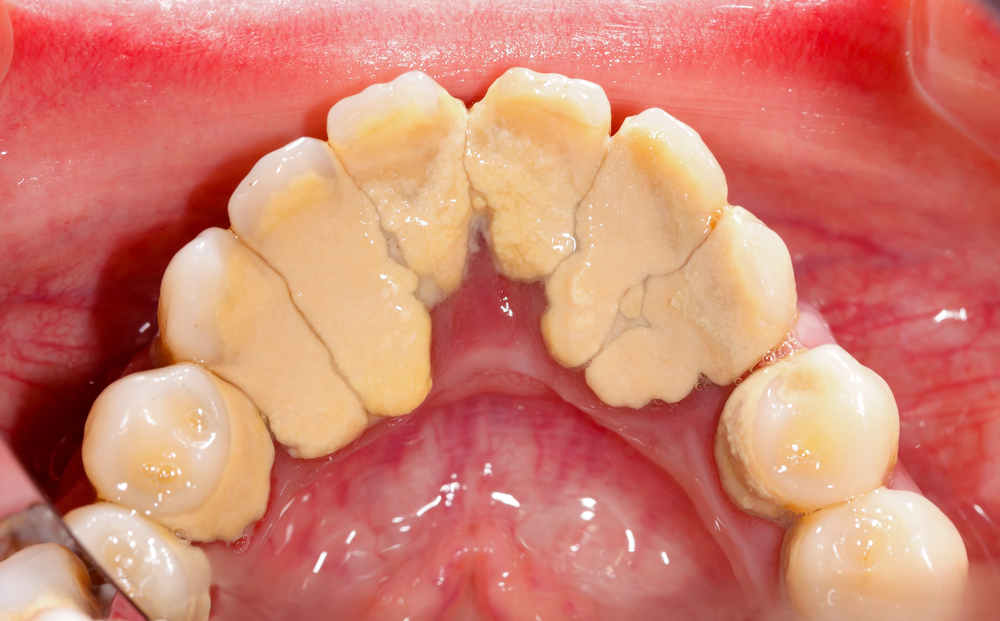A lot of dental tartar on the inner side of the lower teeth