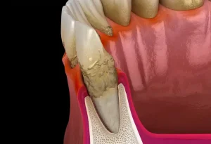 Illustration of advanced periodontitis with inflamed gums, tartar and bone loss around the tooth