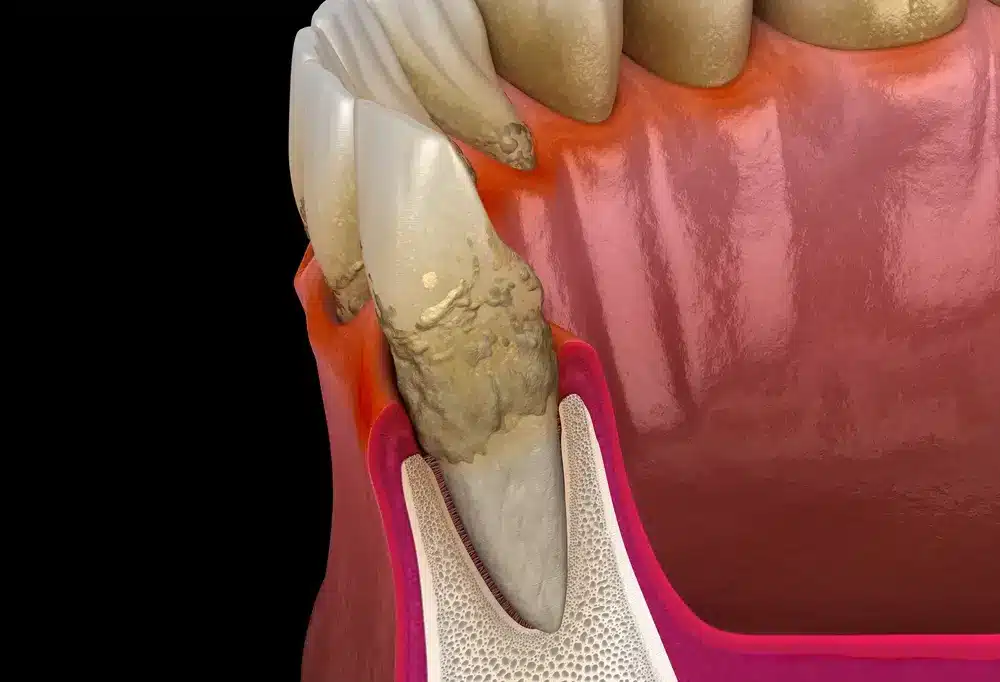 Illustration of advanced periodontitis with inflamed gums, tartar and bone loss around the tooth