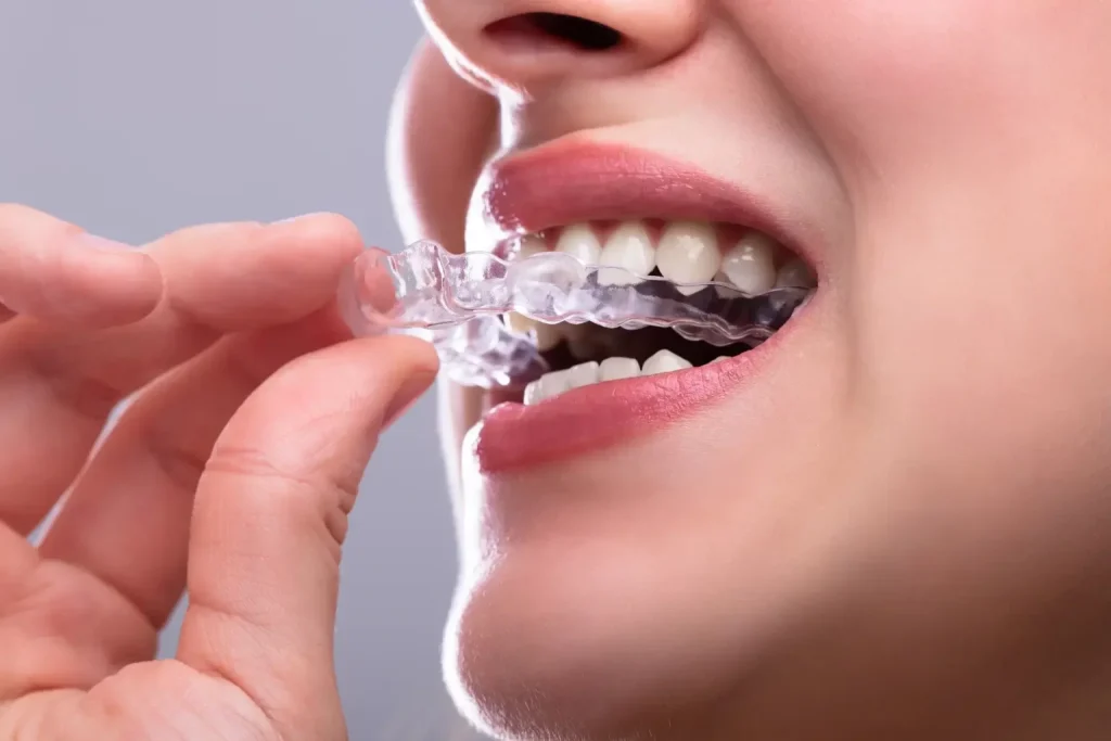 Patient being treated for bruxism with a custom night guard splint