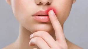 Close-up of a cold sore (oral herpes) on the lip