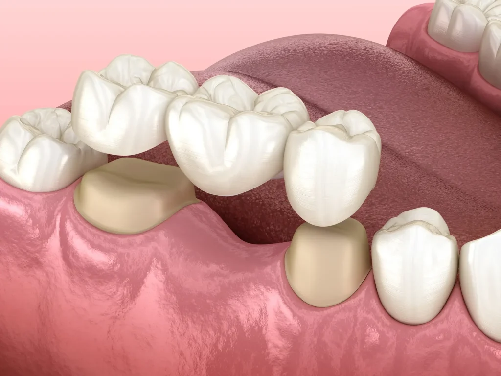 Dental bridge fitted in the mouth to replace missing teeth