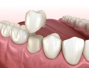 Dental cap placed in a patient's mouth