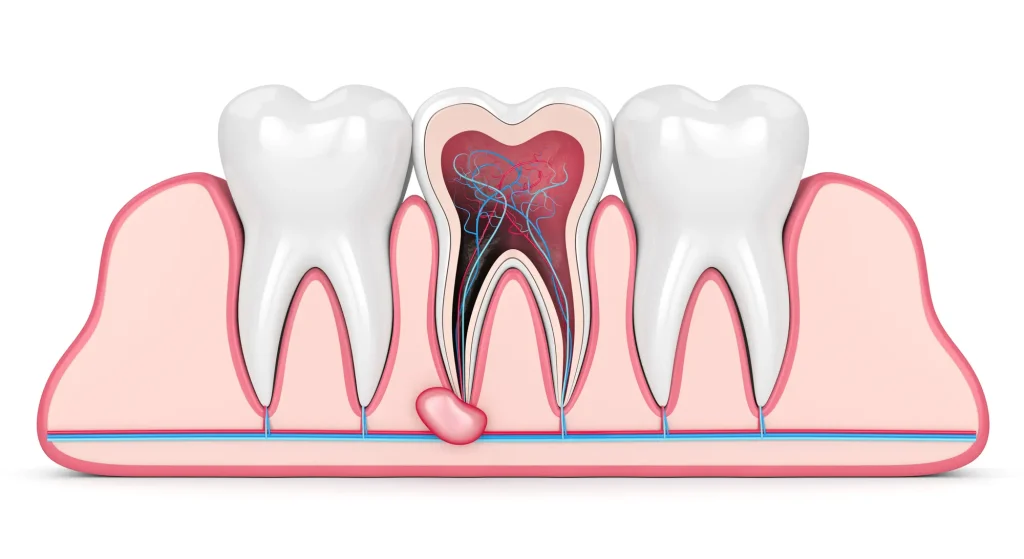 Illustration of a dental granuloma at the tip of a tooth root