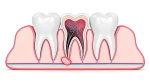 Illustration of a dental granuloma at the tip of a tooth root