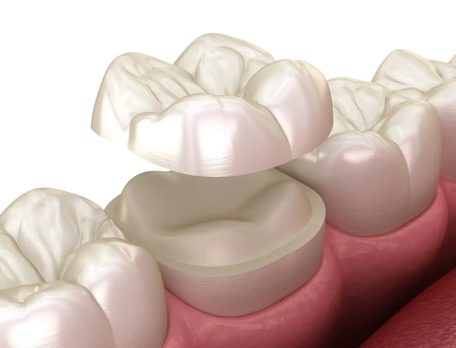 Dental onlay restoration shown on a white background