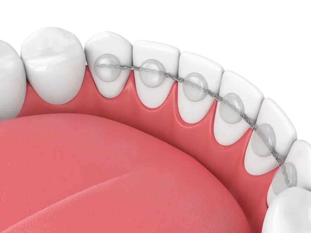 A fixed retainer wire on the inner side of the teeth.