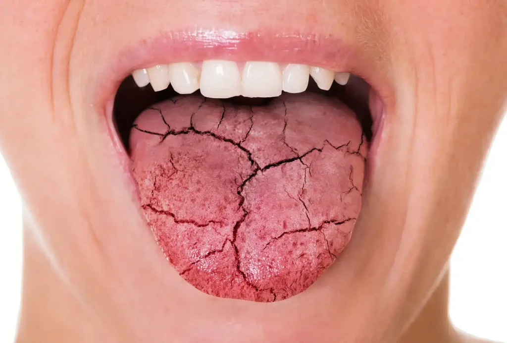 Patient with a dry mouth and tongue