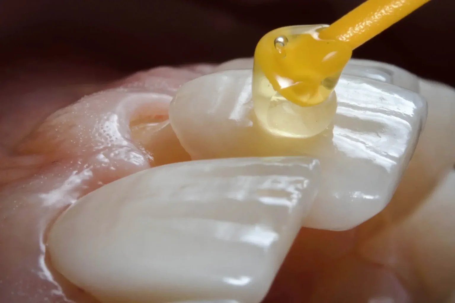 Dentist fitting a dental cap in a patient's mouth