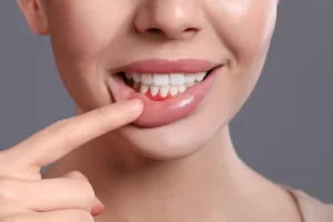 Patient with inflamed gums (gingivitis)