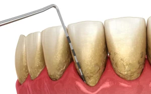 Illustration of gum recession caused by poor oral hygiene