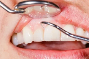 A patient with a gummy smile showing a visible gum line