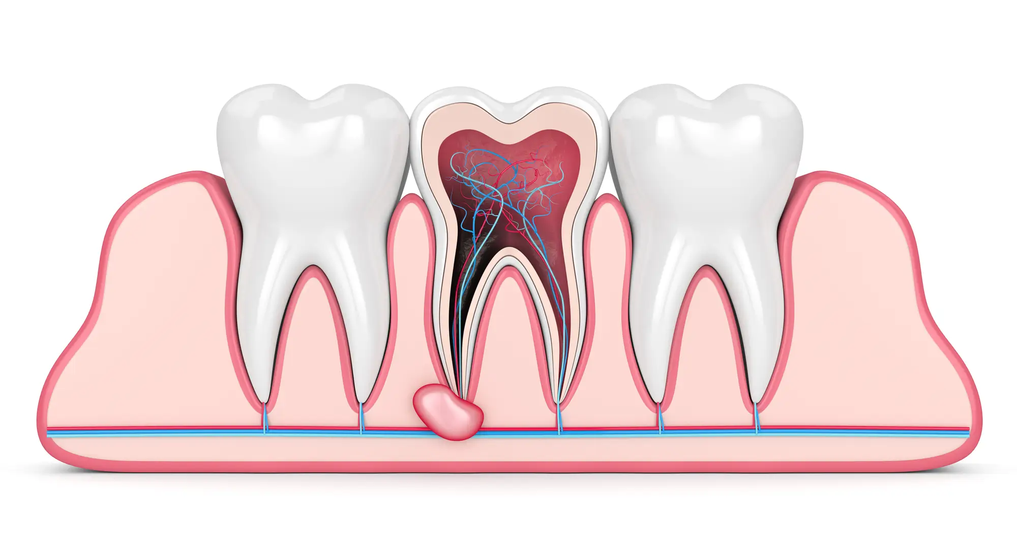 Illustration of a dental granuloma at the tip of a tooth root