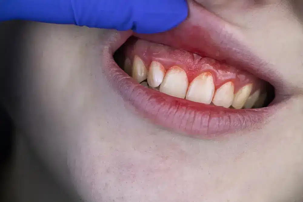 Person with visibly red and swollen gums indicating gum inflammation (gingivitis)