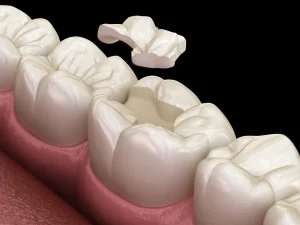 3D illustration of a dental inlay