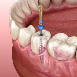 Endodontic root canal treatment at a dental clinic