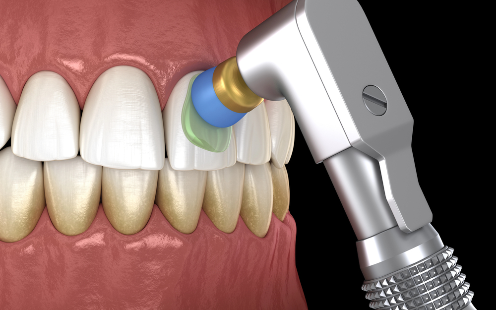 Professional teeth polishing to remove surface deposits and stains