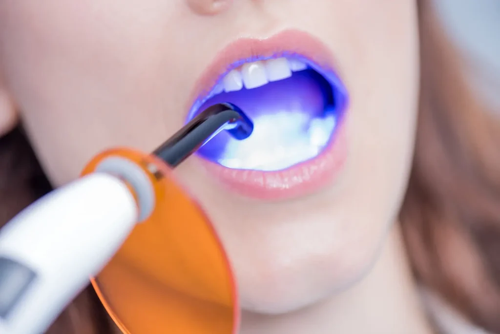 Patient during a tooth bonding procedure at the dentist