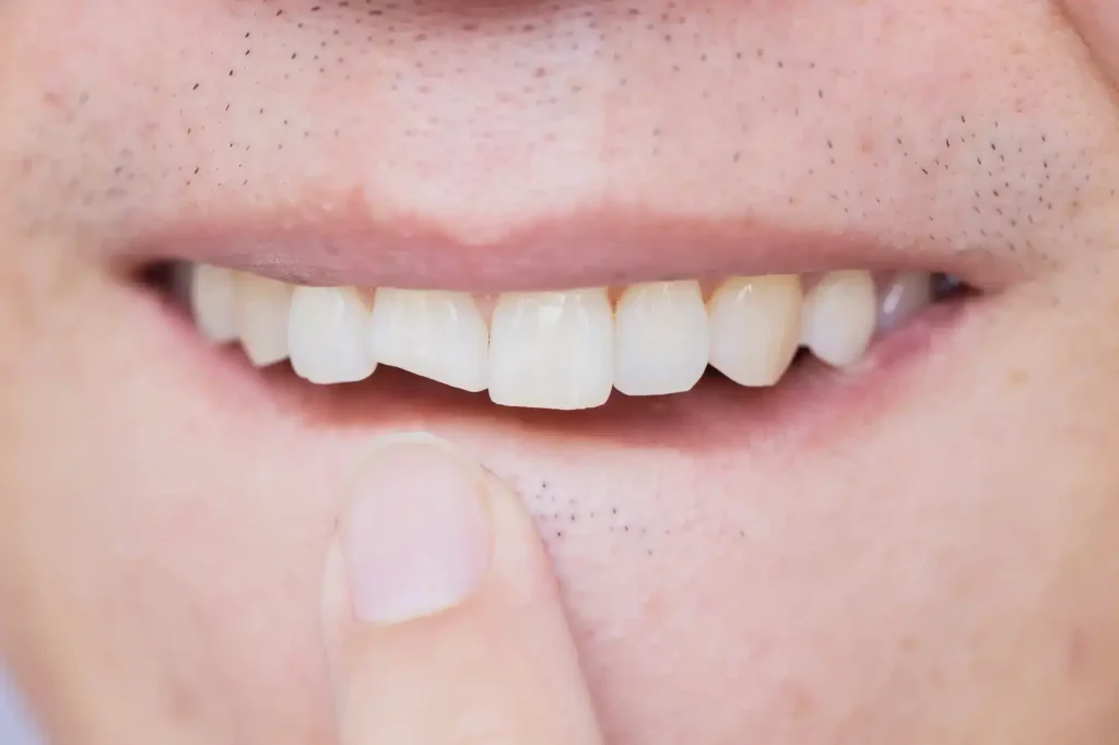 Close-up of a chipped front tooth.