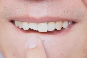 Close-up of a chipped front tooth.