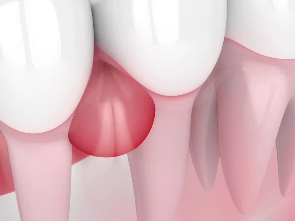 Illustration of an abscess on the gum near a tooth root