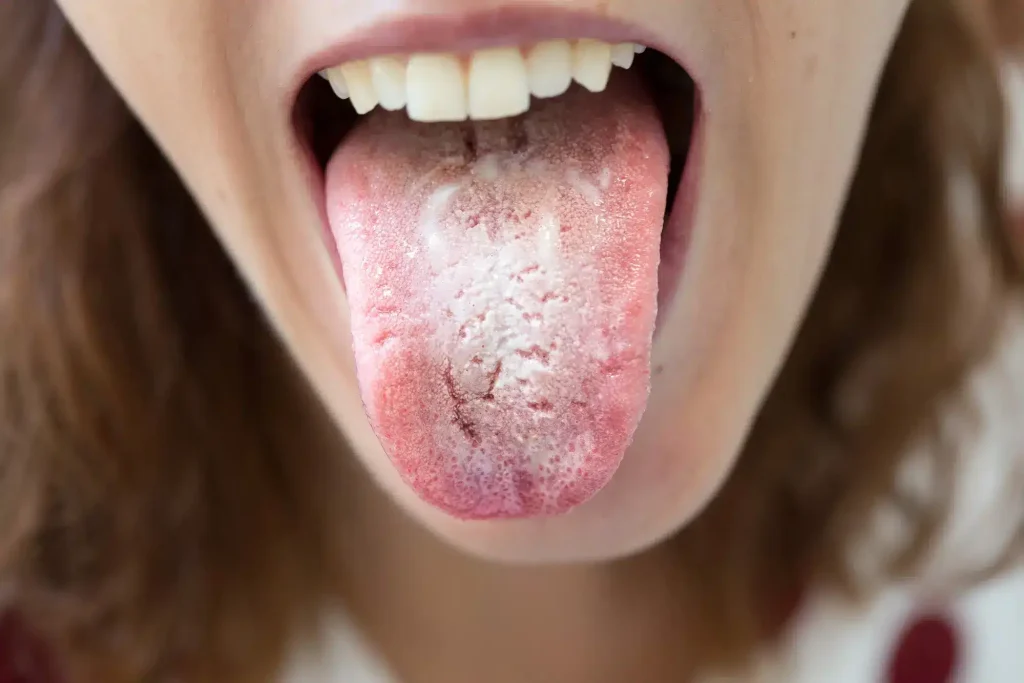 Person checking a white coating on their tongue