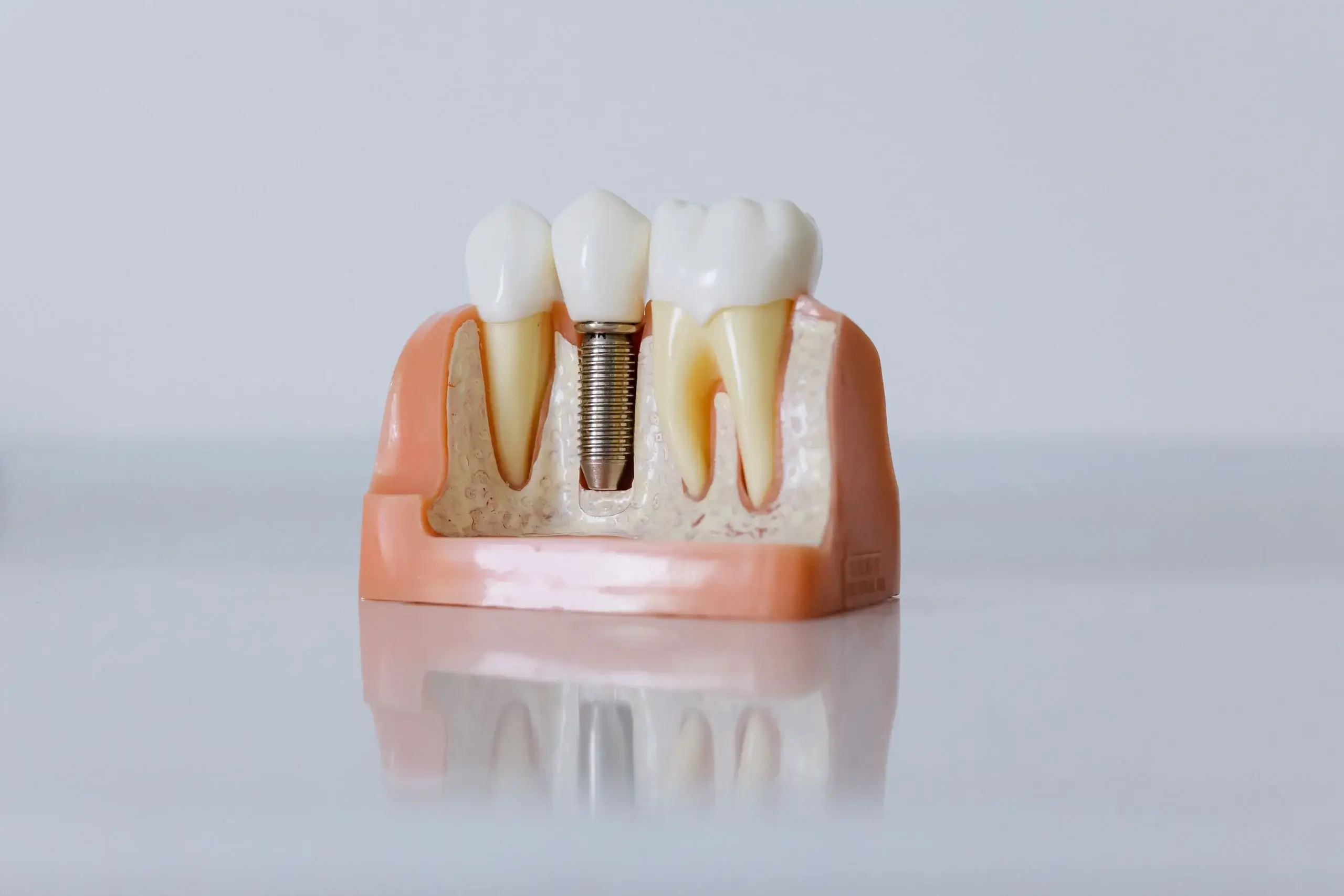 Dental implant treatment illustration