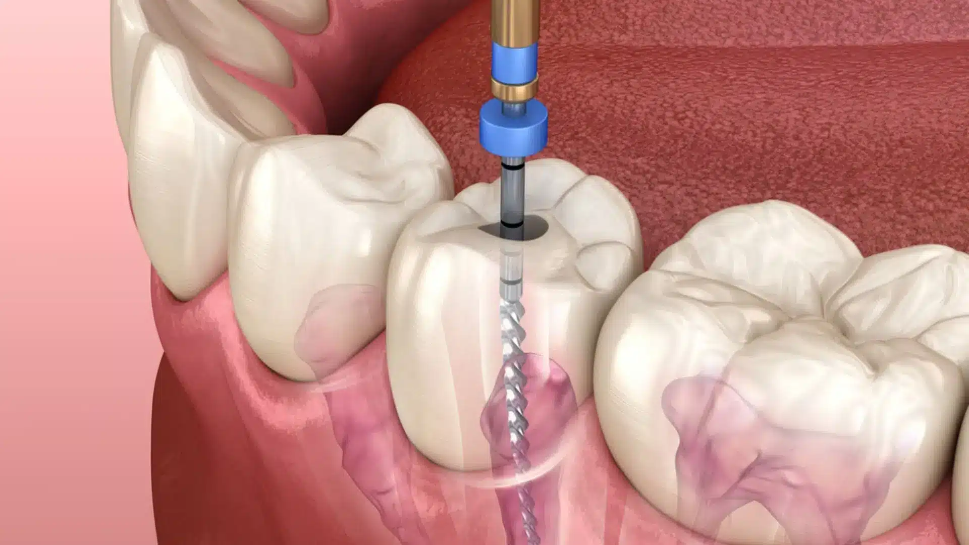 Endodont pri OrthoDentalu pregleduje rentgensko sliko zoba pred koreninskim zdravljenjem.