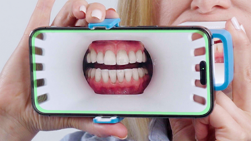 Pametni telefon z nastavkom za snemanje ustne votline prikazuje natančen posnetek zob in dlesni med dentalnim pregledom na daljavo.