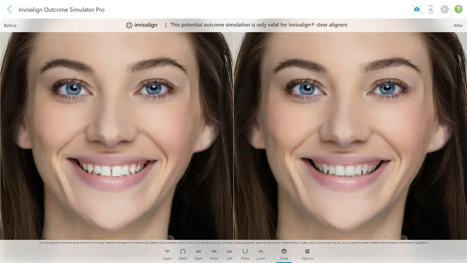 Simulacija Invisalign levo prikazana oseba s prvotnim nasmehom in vidnimi nepravilnostmi zob, desno prikazana ista oseba po digitalni simulaciji poravnanih zob z enakim izrazom obraza.